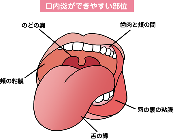 広島市安佐北区　歯医者　口内炎ができやすい部位