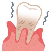 安佐北区　歯医者　歯周病予防効果