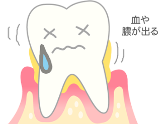 安佐北区　歯医者　虫歯がなくても歯周病のリスクは十分にある