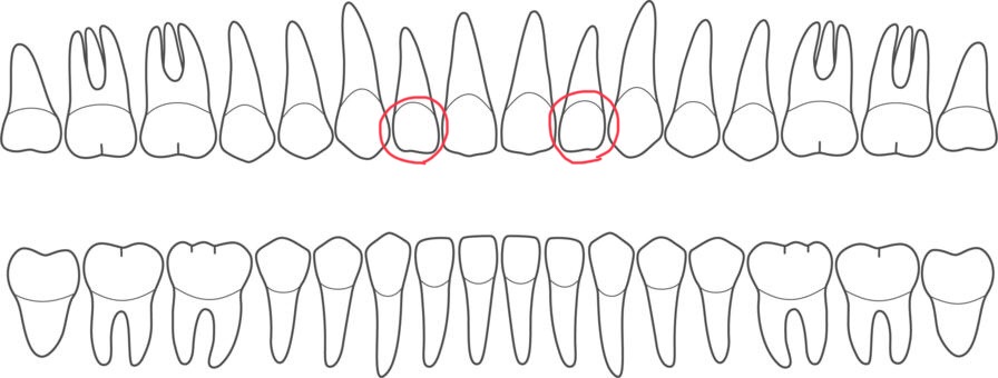安佐北区 歯医者 犬歯の位置と形の特徴