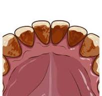 安佐北区　歯医者　着色・黄ばみ除去効果