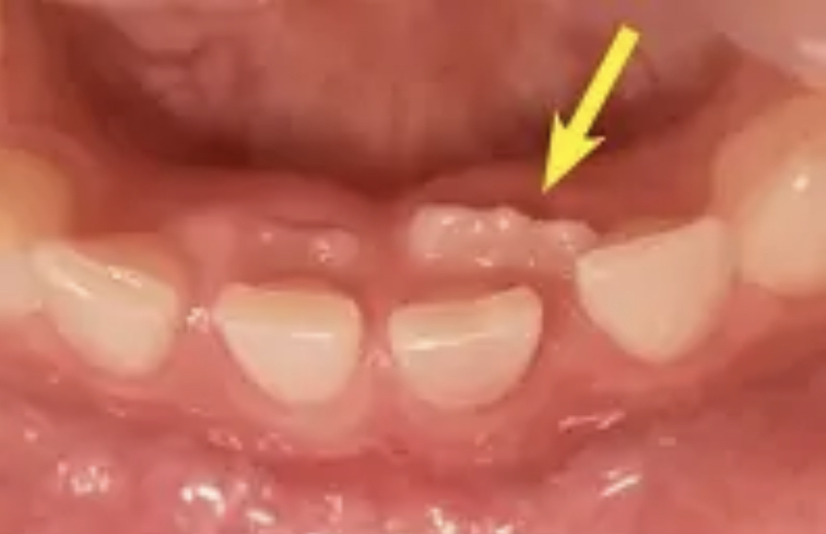 安佐北区 歯医者 永久歯が「二枚歯」になる