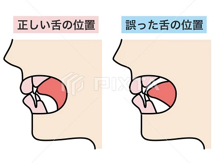 安佐北区　歯医者　正しい舌の位置「スポット」とは？