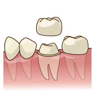 安佐北区　歯医者　根管治療後に被せ物が必要な理由
