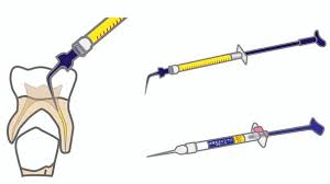 安佐北区　歯医者　根管治療はなぜ回数がかかるの？