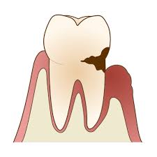 安佐北区　歯医者　歯冠長延長が必要になる機能的なケース