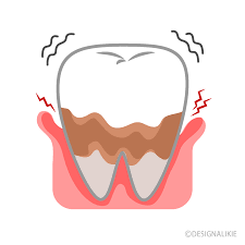 安佐北区　歯医者　重度歯周炎