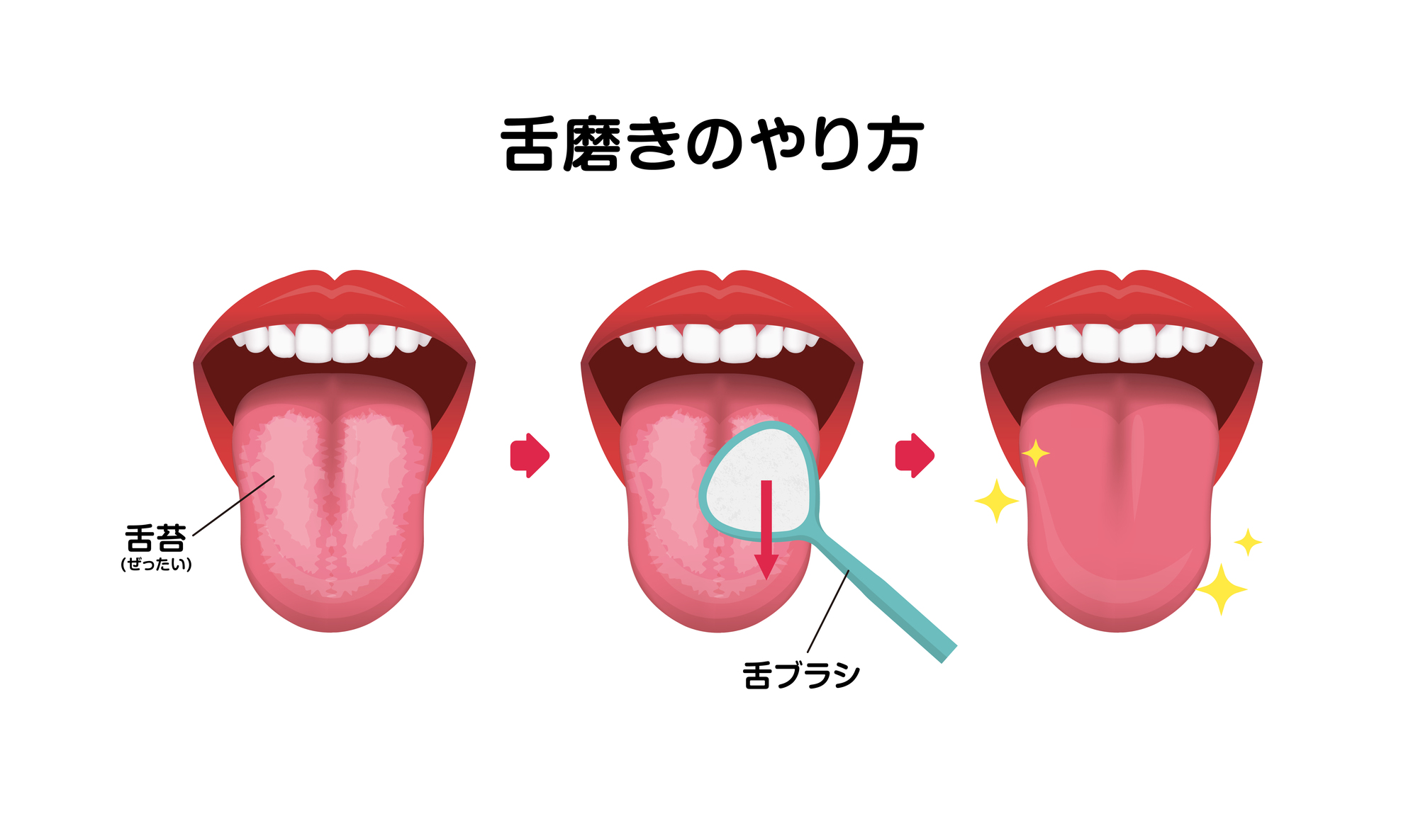 安佐北区　歯医者　磨き方のポイント