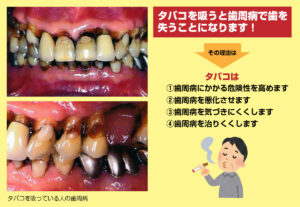 安佐北区の歯医者「かわもと歯科・こども歯科クリニック」のタバコは歯周病にも関係する?