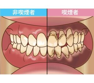 安佐北区の歯医者「かわもと歯科・こども歯科クリニック」のタバコは口臭の原因にもなる?
